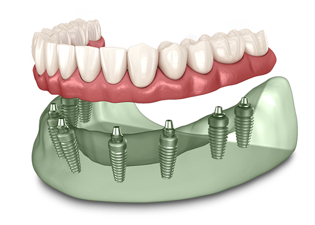 full arch implant rehabilitation near you